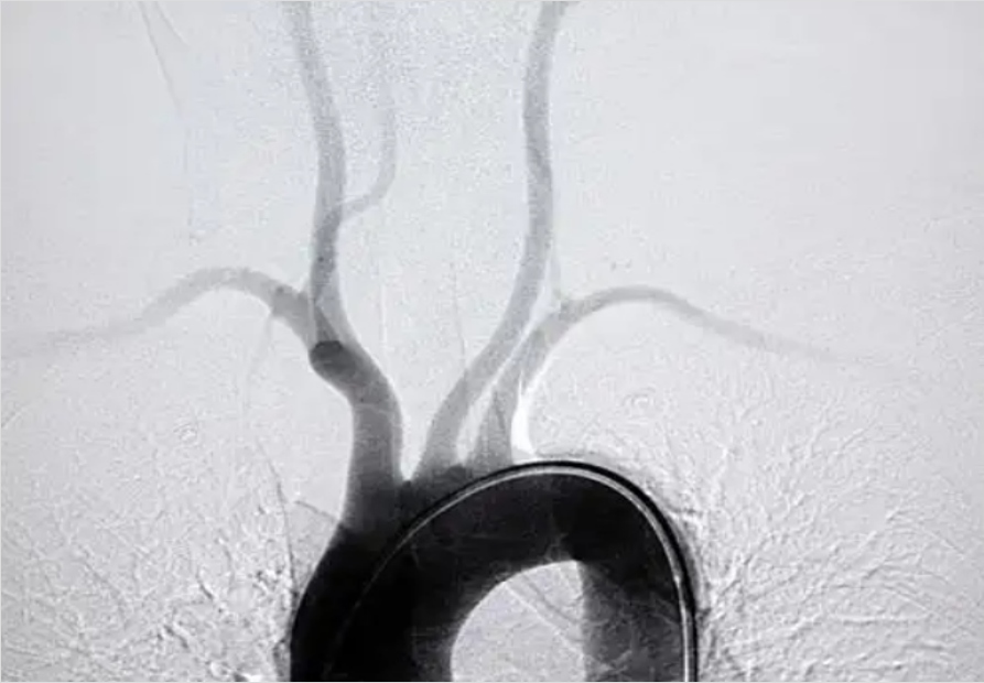 3D打印來(lái)幫忙心臟大血管手術(shù)更精準(zhǔn)