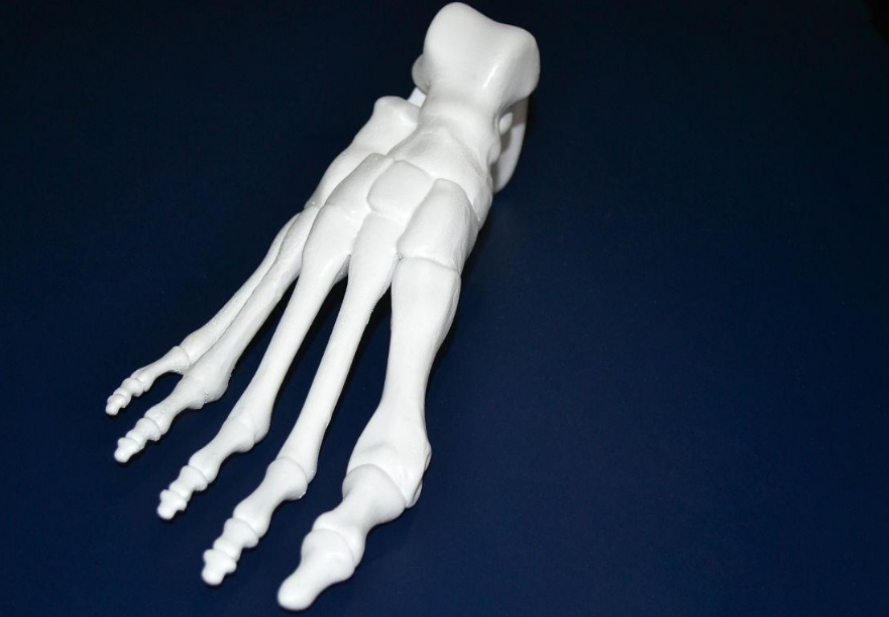 3D打印骨骼模型給患者的康復(fù)指南
