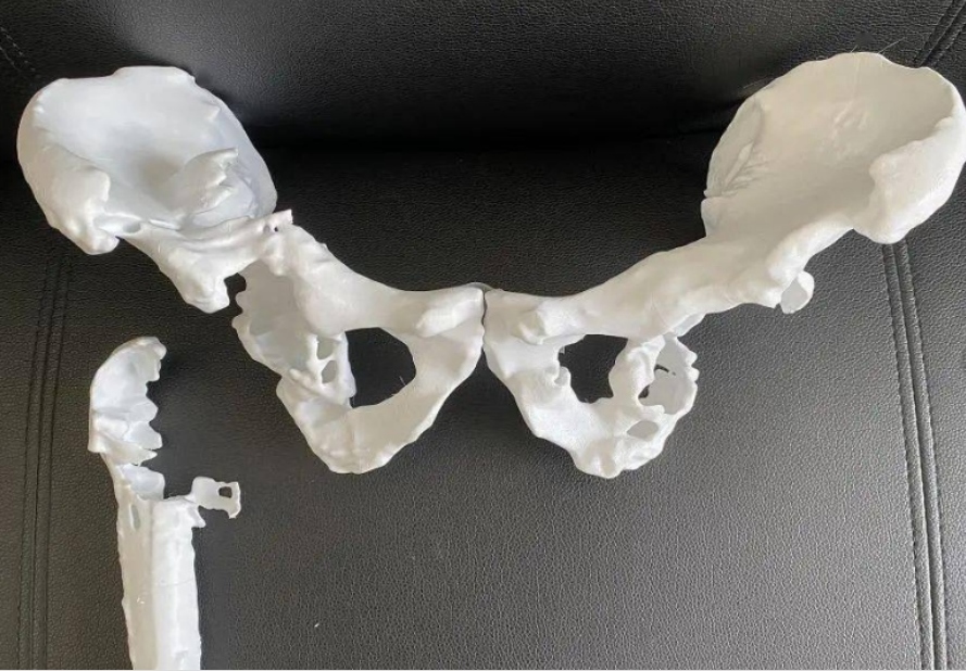 3D打印椎骨給脊柱手術(shù)裝個(gè)安全保險(xiǎn)